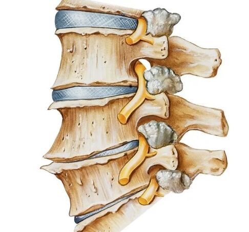 Pinching of the nerve in the spine