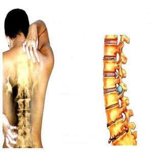 Osteochondrosis steps