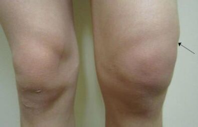 Clinical manifestations of osteoarthritis of the knee joint