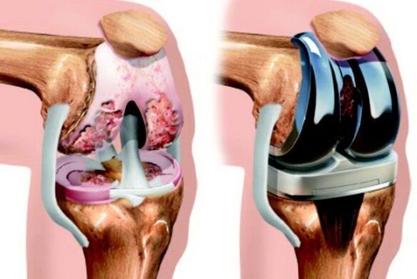 Before and after the endoprosthetic of the knee joint with osteoarthritis