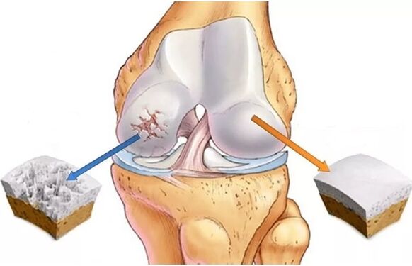 Healthy cartilage and cartilage affected by osteoarthritis