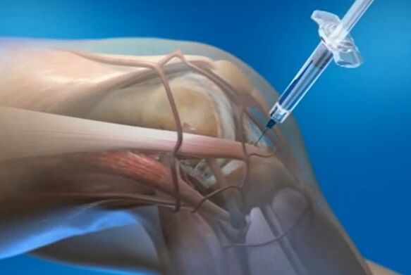 intra-articular injections for osteoarthritis of the knee joint